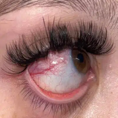 Allergic Reaction to Eyelash Extensions