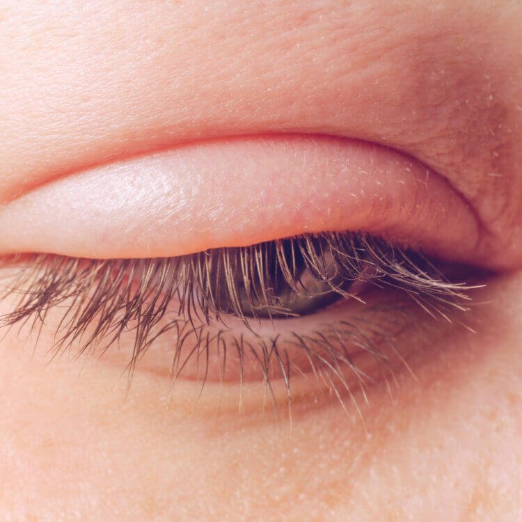 Why Eyelashes Fall Out?