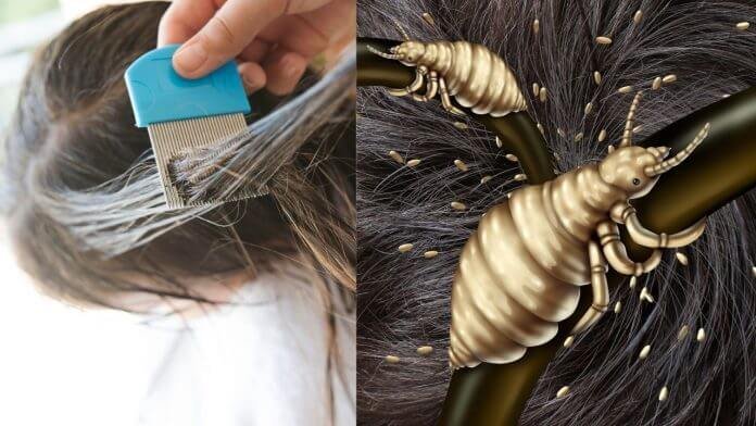 Can hair dye eliminate lice